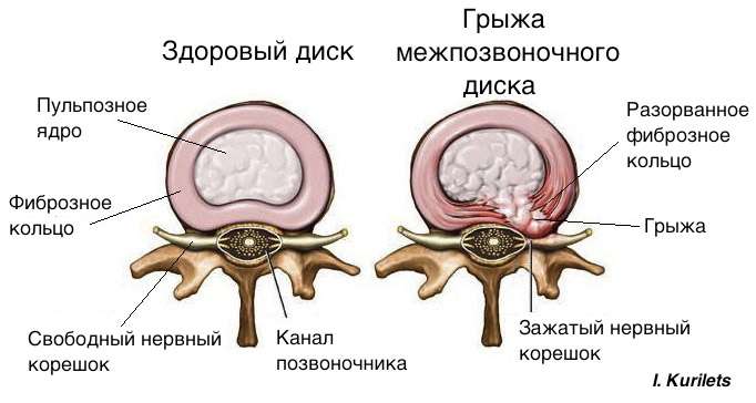 грыжа+18+07